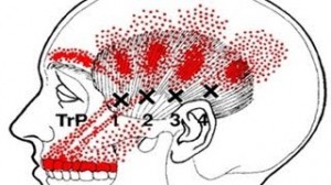 Common Hot Spots with Migraine Headaches
